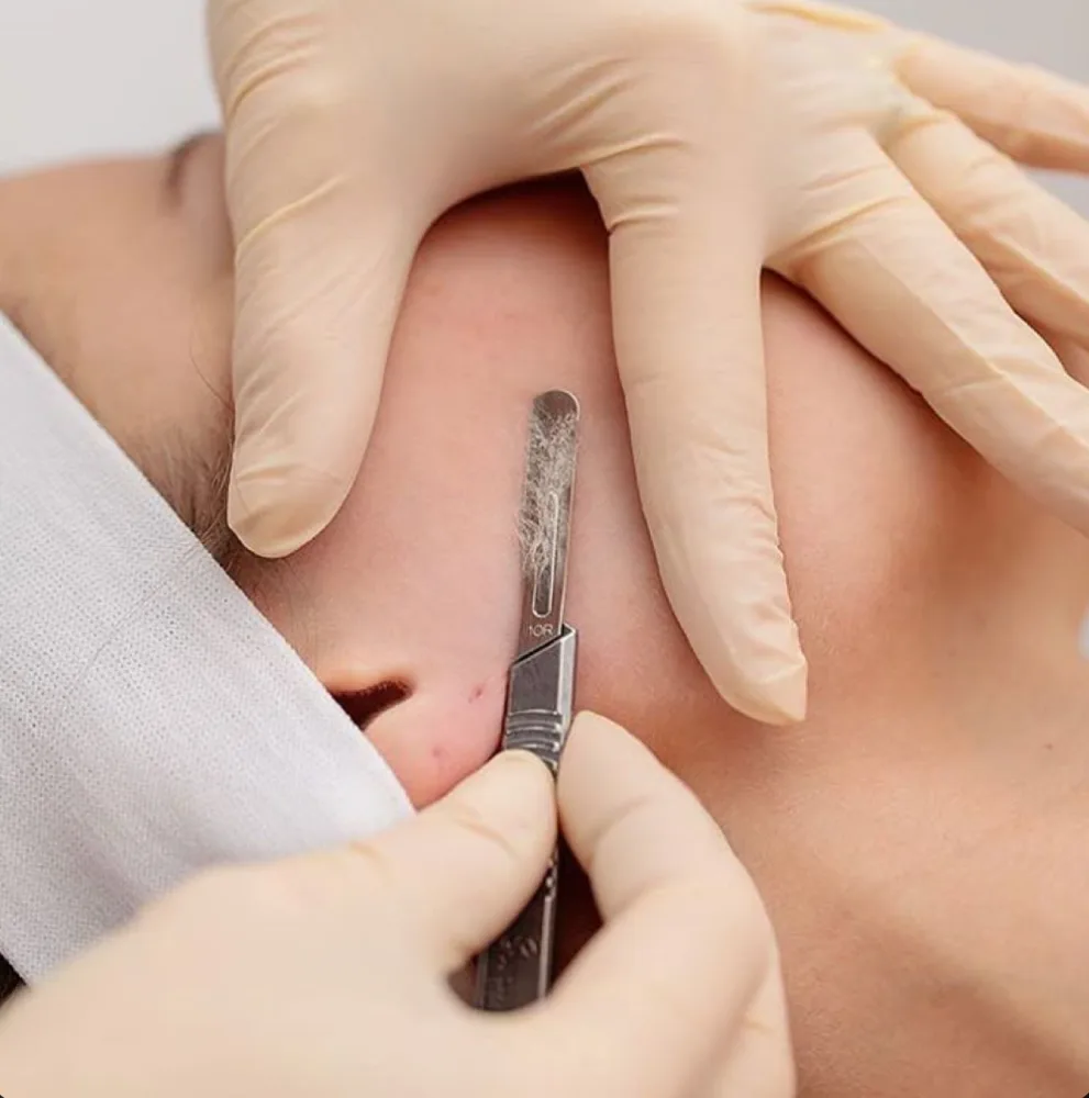A skincare professional performing dermaplaning during a Just Dermaplaning 30 Min facial treatment.